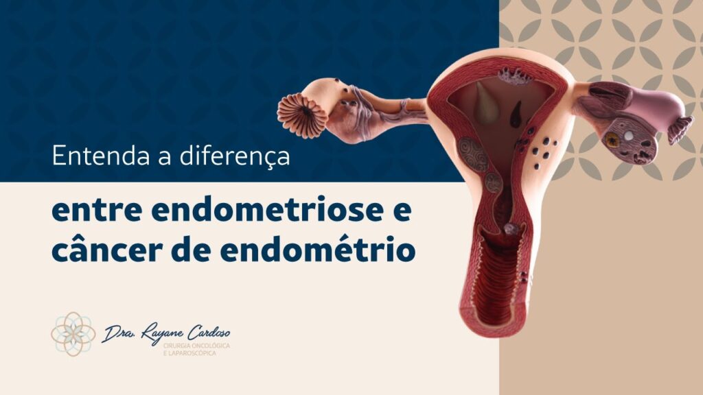 V Deo Entenda A Diferen A Entre Endometriose E C Ncer De Endom Trio