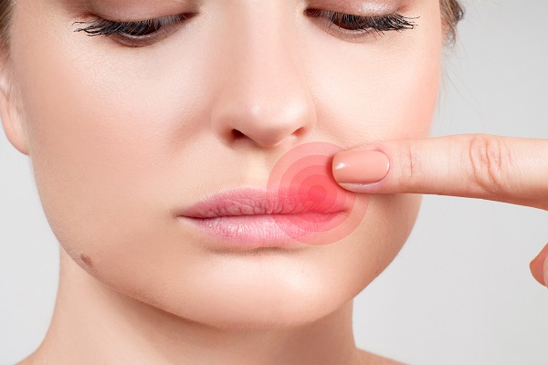 Herpes Labial 3 Ch s para Usar Hoje Mesmo