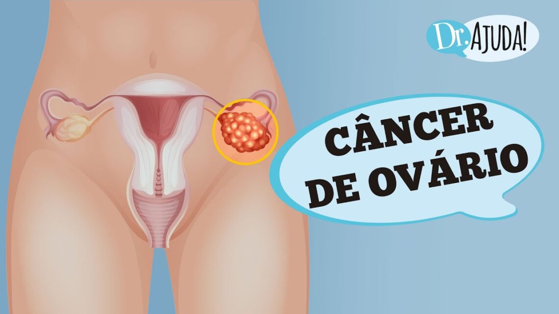 CANCER-DE-OVARIO-SINTOMAS-DIAGNOSTICO-E-TRATAMENTO