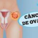 CANCER-DE-OVARIO-SINTOMAS-DIAGNOSTICO-E-TRATAMENTO