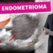 Endometrioma-cisto-de-ovario-da-endometriose