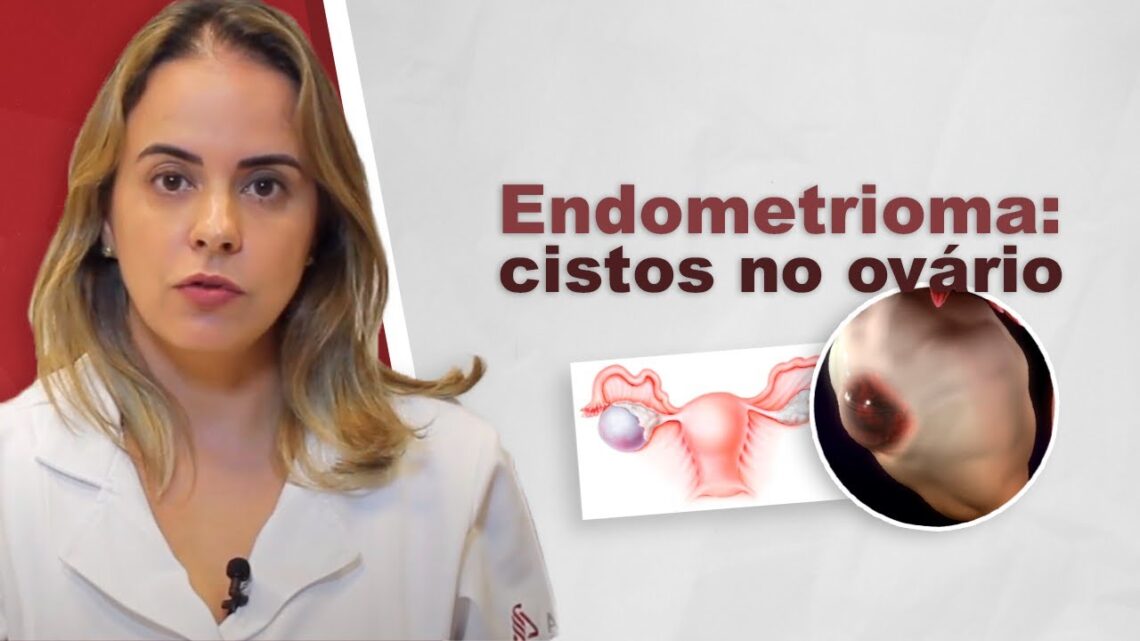 Endometrioma-cistos-de-endometriose-no-ovario