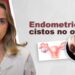 Endometrioma-cistos-de-endometriose-no-ovario