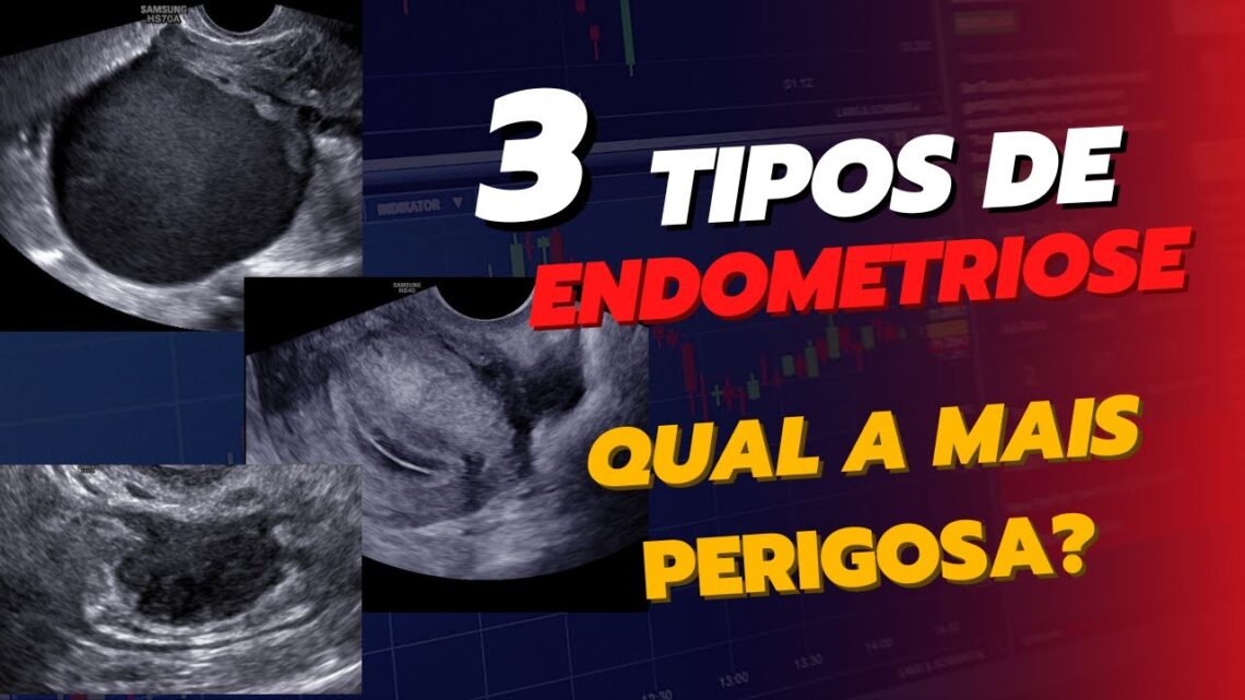 O-3-tipos-de-ENDOMETRIOSE-Qual-o-mais-perigoso