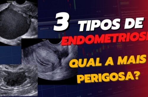 O-3-tipos-de-ENDOMETRIOSE-Qual-o-mais-perigoso